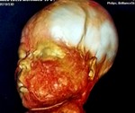 Hemimegalencephaly with prominent ipsilateral facial hypertrophy