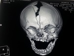 Hemimegalencephaly with prominent ipsilateral facial hypertrophy